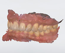 パソコン上で表示された歯のCG模型
